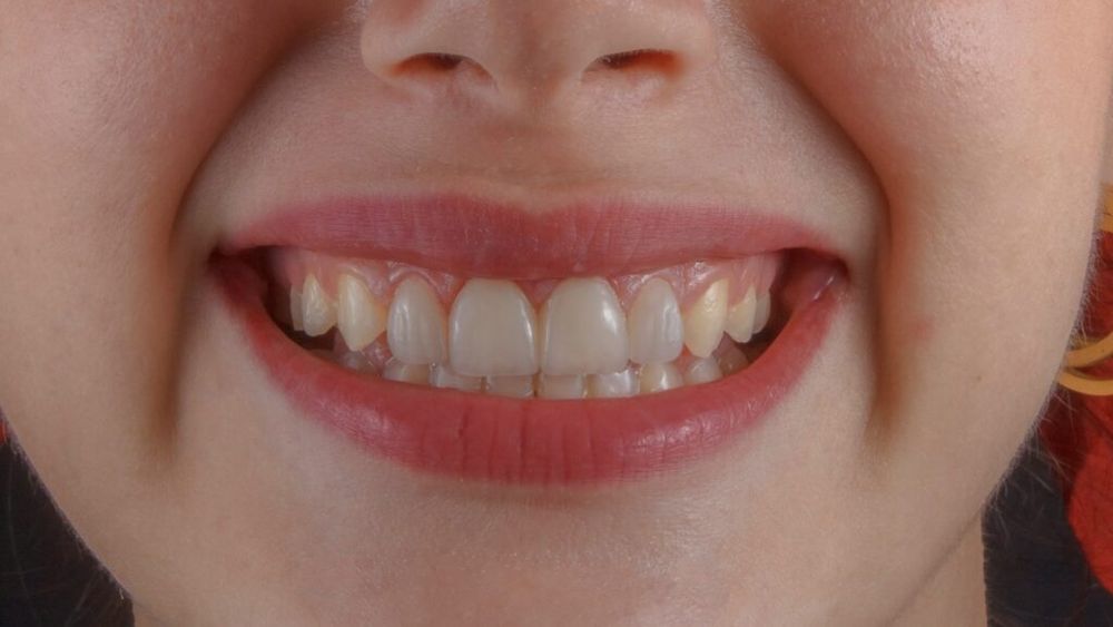 Deși ți se spune că fructele sunt sănătoase, dentiștii te sfătuiesc să le consumi cu atenție/ Ortodont: „Anumite fructe au pigmenți naturali foarte puternici și îți pătează dinții”