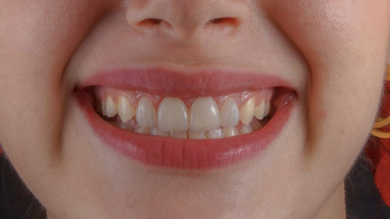 Deși ți se spune că fructele sunt sănătoase, dentiștii te sfătuiesc să le consumi cu atenție/ Ortodont: „Anumite fructe au pigmenți naturali foarte puternici și îți pătează dinții”