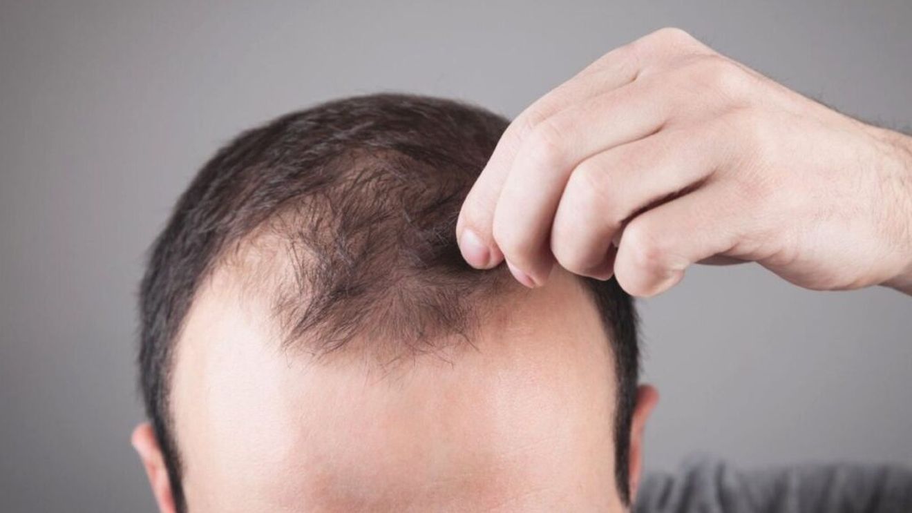 Există o legătură între chelie și alimentație? Expertă în sănătatea părului explică de ce mezelurile sau brânza pot influența căderea părului la bărbații cu alopecie androgenetică