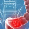 Credea că e din cauză că mănâncă alimente roșii. Cum a descoperit o adolescentă că suferă de cancer de colon