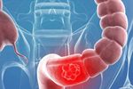 Credea că e din cauză că mănâncă alimente roșii. Cum a descoperit o adolescentă că suferă de cancer de colon
