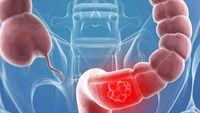 Credea că e din cauză că mănâncă alimente roșii. Cum a descoperit o adolescentă că suferă de cancer de colon
