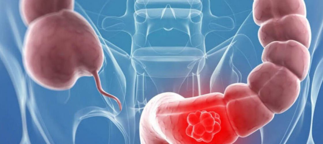 Credea că e din cauză că mănâncă alimente roșii. Cum a descoperit o adolescentă că suferă de cancer de colon