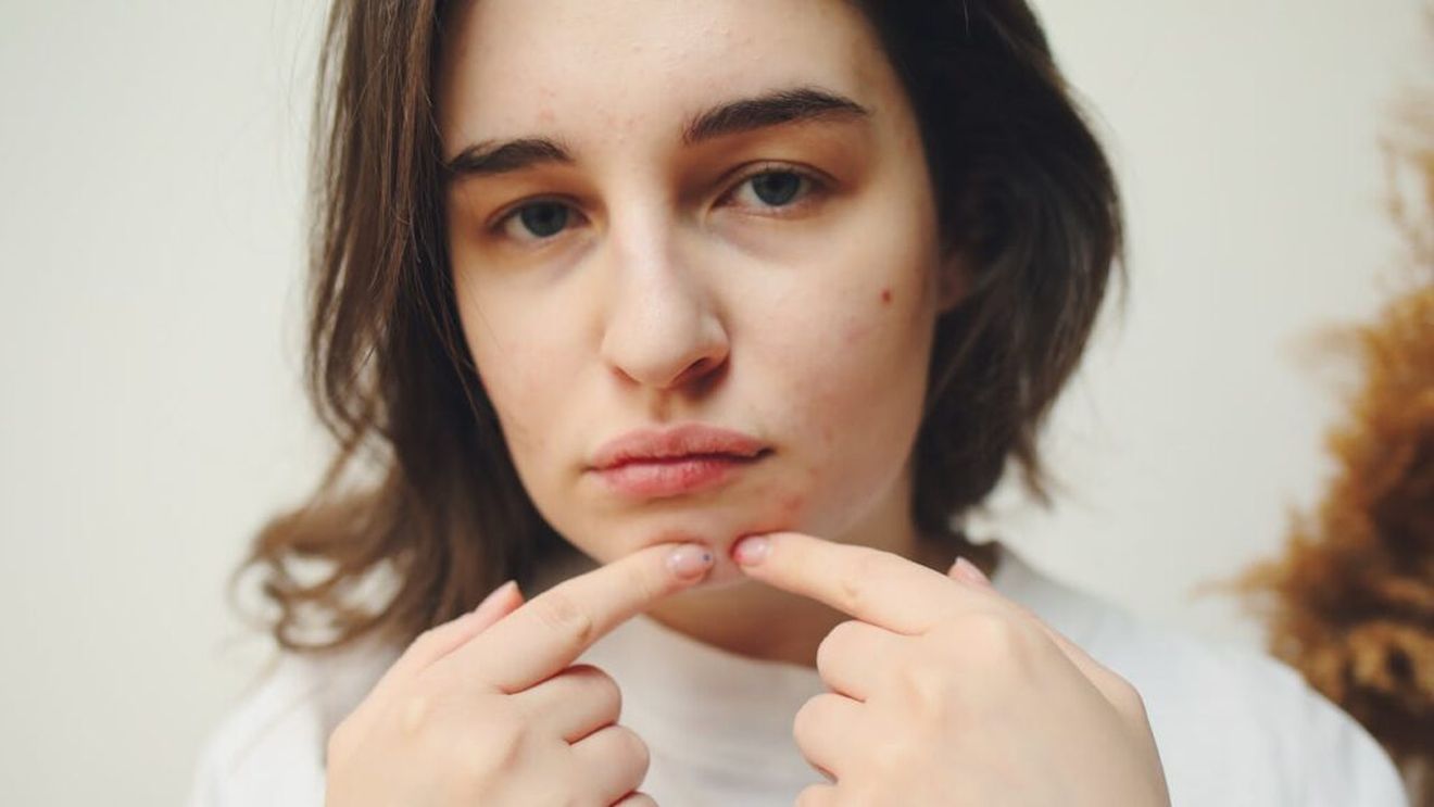 Incidența acneei la adolescenți în creștere alarmantă în Europa. Printre cauze: alimentația, obezitatea, stresul și poluarea